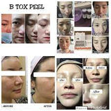 Matrigen B-Tox Peel (Herbal Peel/No Needle)
