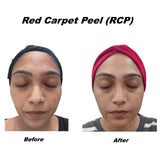 Before and after comparison of a facial peel treatment labeled 'Red Carpet Chemical Peel (RCP)'. The best chemical peel