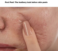 14% Jessner Chemical Peel for Professional Use - pH 1.9