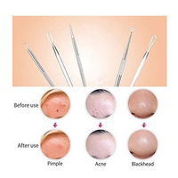 Blackhead Removal Tool Kit (Professional and Home Use) - 9Pieces